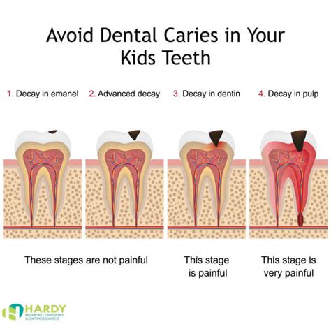 cavities in kids under 5.